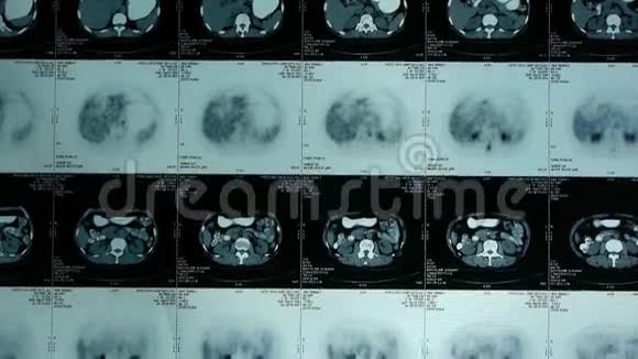 动人体器官petct扫描淋巴结X线肿瘤转移视频的预览图
