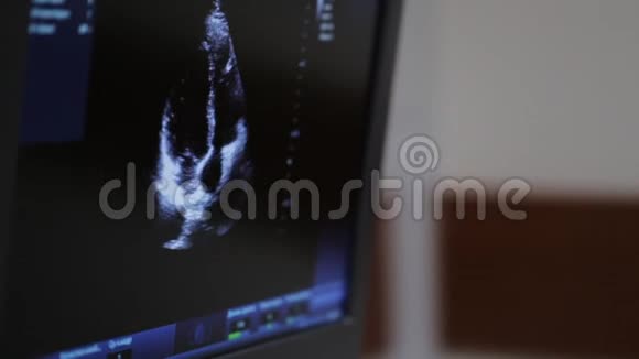心脏超声检查监视器屏幕极端关闭视频的预览图