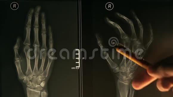 医生向病人解释手的x射线图像颜色温暖4K特写视频视频的预览图
