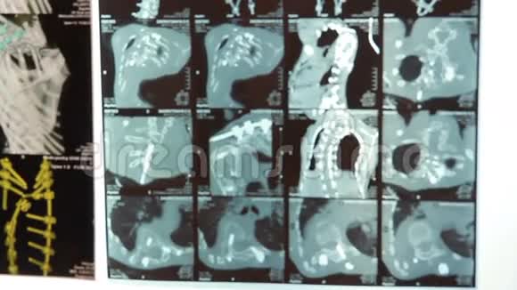 CT及MRI扫描阴性视频的预览图
