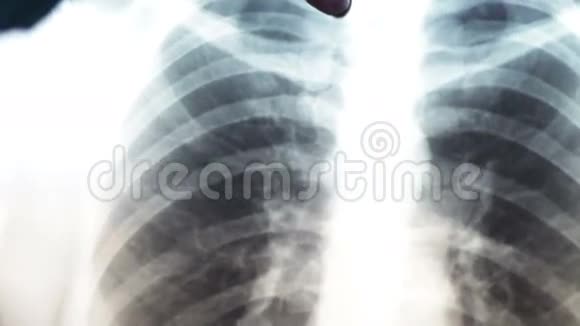 人肺X线预防肺癌的诊断视频的预览图
