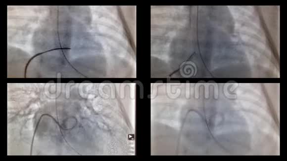 X光中心脏和血管的导管化视频的预览图