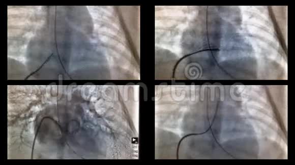 X光中心脏和血管的导管化视频的预览图