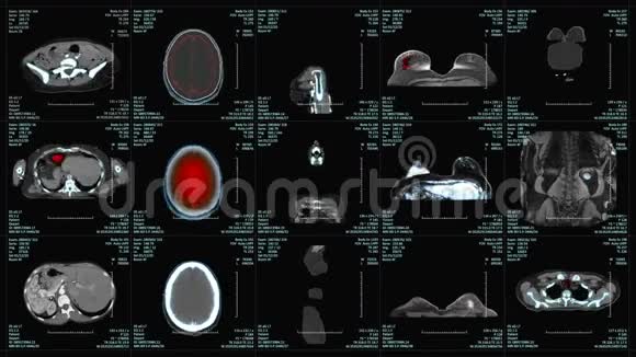 核磁共振扫描屏幕附加医疗数据视频的预览图