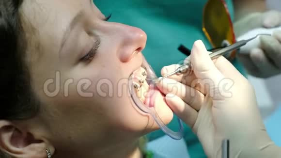 安装金属支架收口去看牙医矫正畸形治疗牙齿视频的预览图