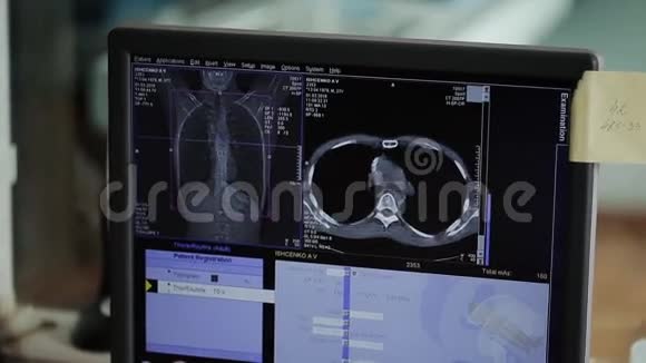 病人胸部三维模型的CT重建视频的预览图