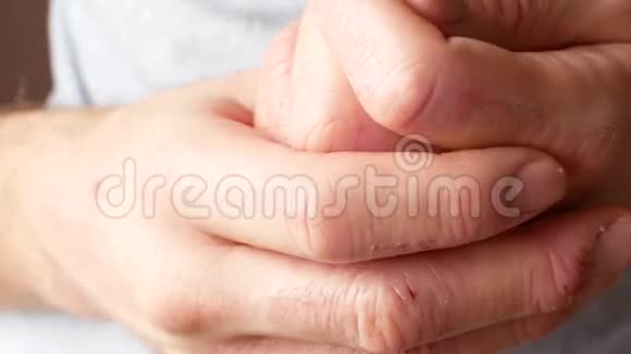 一个人用奶油涂抹他的手手的银屑病患者皮肤上的皮炎视频的预览图