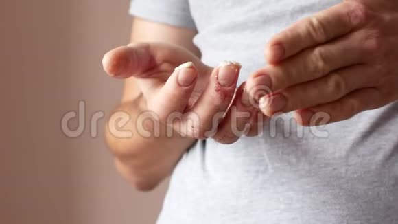 一个人用奶油涂抹他的手手的银屑病患者皮肤上的皮炎视频的预览图