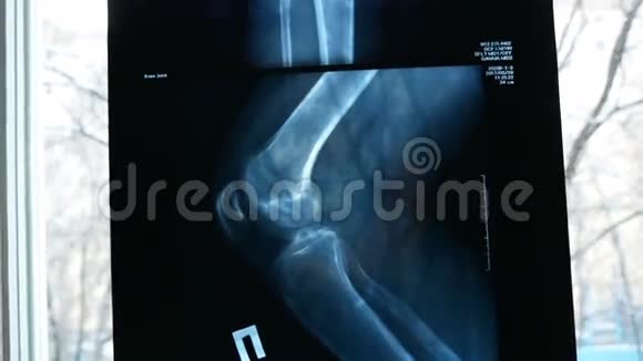 X线照片显示膝关节伴关节炎视频的预览图