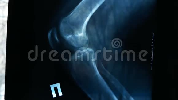 X线照片显示膝关节伴关节炎视频的预览图