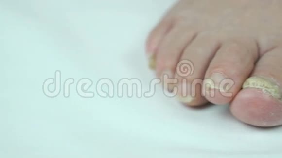 女性脚指甲真菌感染视频的预览图