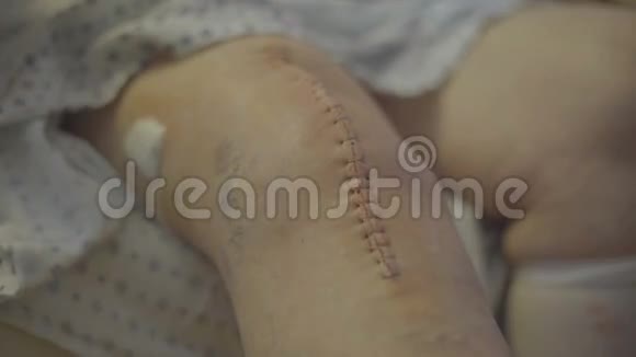 膝关节置换疤痕和订书机视频的预览图