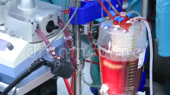 体外循环泵血装置视频的预览图