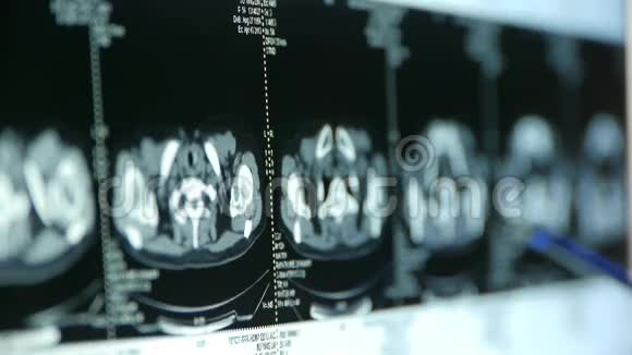 医生研究锁骨下petct扫描淋巴结X线肿瘤转移视频的预览图