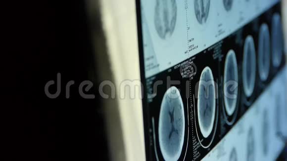 医生研究头部PETct扫描分析疾病颅骨脑X线视频的预览图