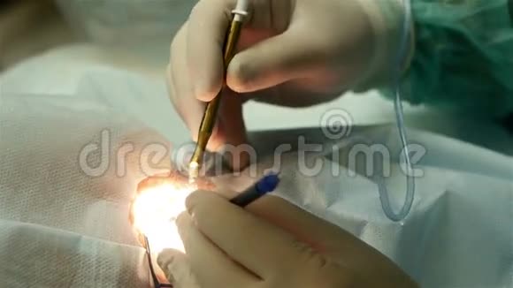 眼科手术医生的双手戴着手套视频的预览图