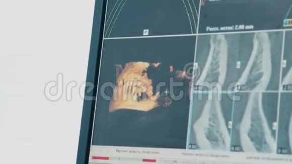 计算机屏幕上颌骨三维模型的特写视频的预览图