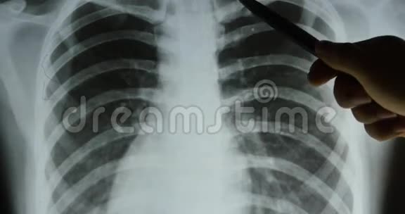 医生研究肋骨肋笼关节X线片进行分析医疗卫生医院视频的预览图