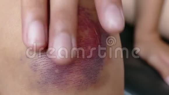 在擦伤的膝盖上用治疗药膏按摩她的手指视频的预览图