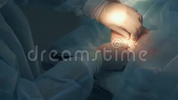 手术室医院踝部湿瘤切除手术视频的预览图