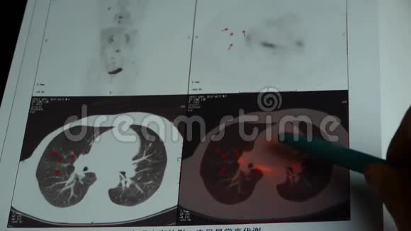 医生研究肺宠物ct医学X线视频的预览图