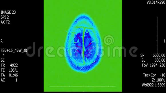真实生命人脑核磁共振扫描与肿瘤医学研究新质量健康科学4k镜头股票动画视频的预览图