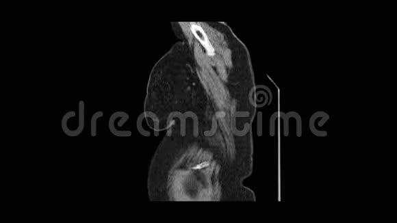 肺部和支气管MRI扫描呼吸系统疾病诊断视频的预览图