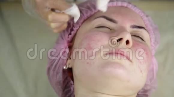 挤压粉刺痤疮治疗年轻女性接受美容治疗的清洁粉刺视频的预览图
