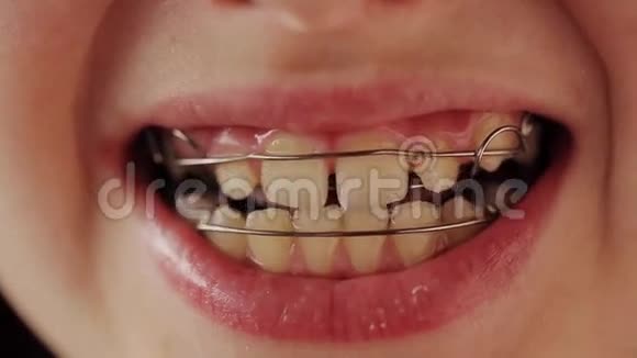 儿童牙齿的牙板视频的预览图