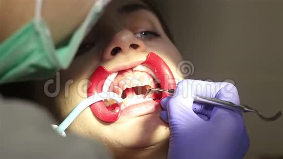 在牙科诊所有扩张器的年轻女子保护美白凝胶在牙齿上的应用视频的预览图