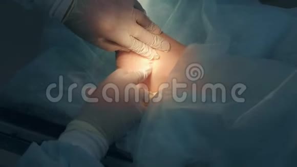 手术室医院踝部湿瘤切除手术视频的预览图