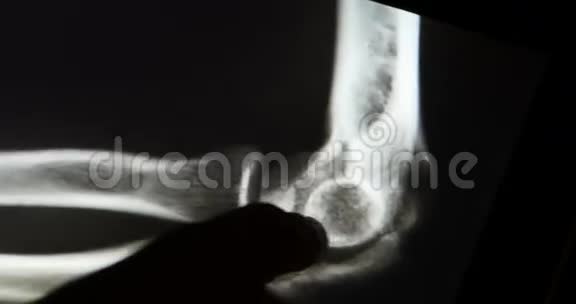 医生研究手臂腿部和手掌关节X线胶片用于触摸屏设备的分析医疗医院视频的预览图