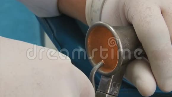 直肠科医生展示了痔疮乳胶环的结扎特写视频的预览图