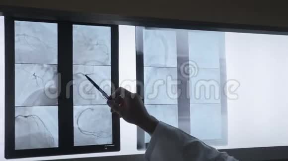 医生手臂检查x光片X线片视频的预览图