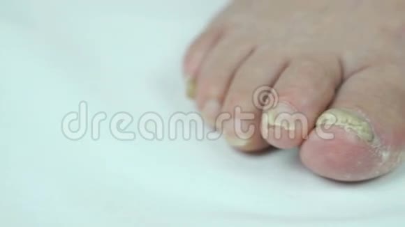 女性足部指甲真菌感染视频的预览图