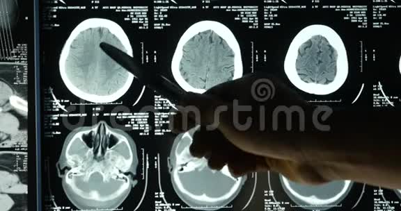 医生研究头骨脑X线片进行分析健康医疗医院视频的预览图