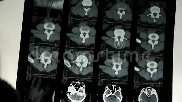 医生研究颅骨脑X线片进行分析小脑脑干视频的预览图