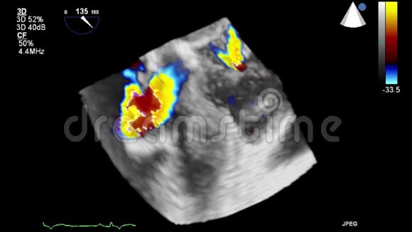 高质量的经食管超声视频三维模式视频的预览图