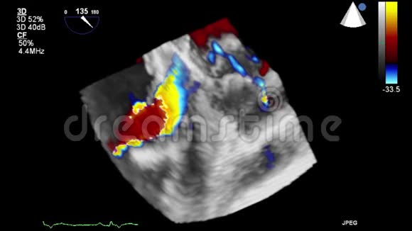 高质量的经食管超声视频三维模式视频的预览图