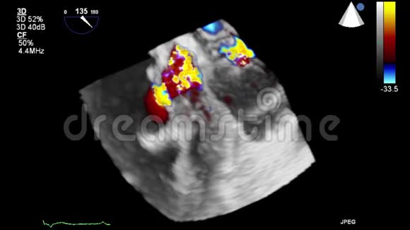 高质量的经食管超声视频三维模式视频的预览图