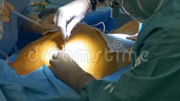 外科医生做胸切除术视频的预览图