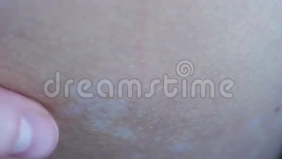 皮肤的疾病颜色的丧失皮肤上的真菌视频的预览图