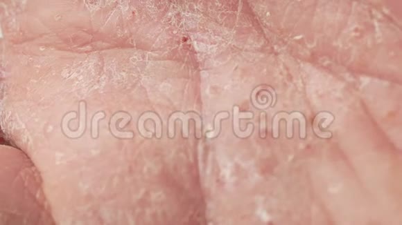 银屑病和湿疹的男性手指皮肤剥落的特写视频的预览图
