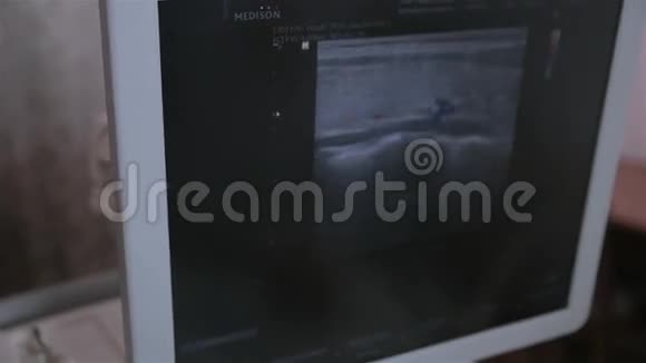 计算机屏幕与甲状腺和甲状旁腺超声视频的预览图