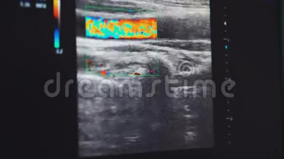 医院现代超声心动图超声监测仪视频的预览图