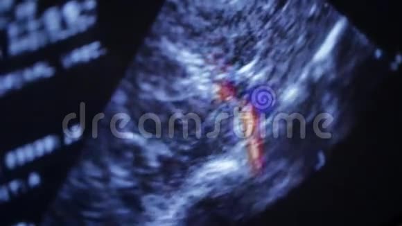 子宫里的超声波宝宝心跳视频的预览图