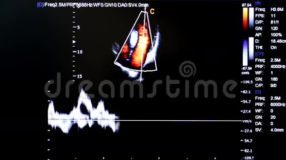 彩色超声监测图像四房宝宝心景视频的预览图
