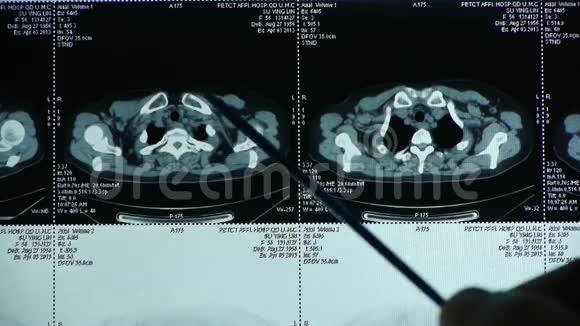 医生研究锁骨下petct扫描淋巴结X线肿瘤转移视频的预览图