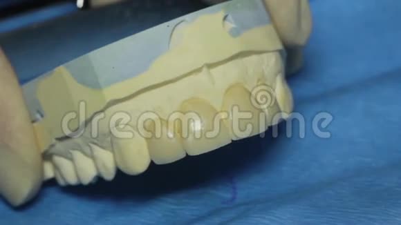 牙科铸造爪义齿牙科贴面视频的预览图
