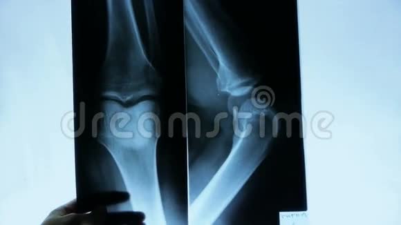 医生研究手臂腿部和手掌关节X线片进行分析视频的预览图